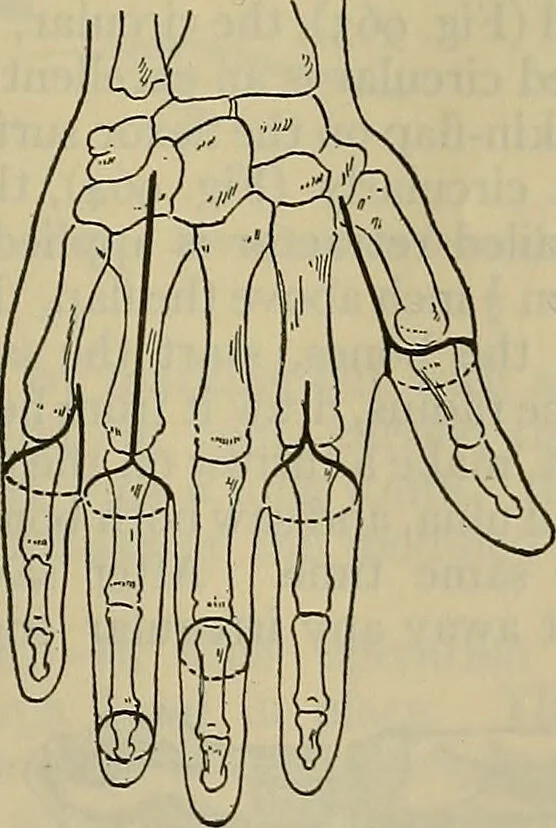 An illustration from Modern surgery, general and operative / by John Chalmers DaCosta., 1914, leaf 1453