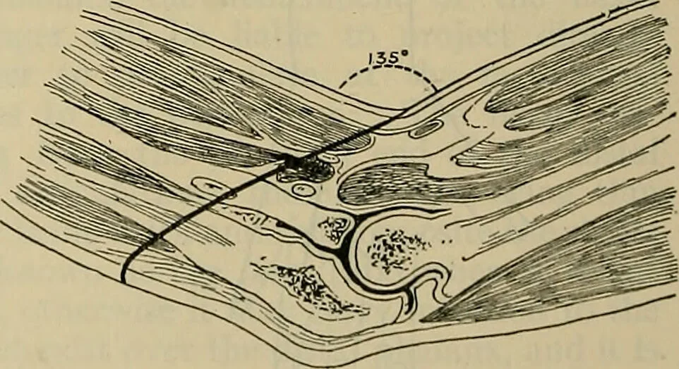 An illustration from Modern surgery, general and operative / by John Chalmers DaCosta., 1914, leaf 1454