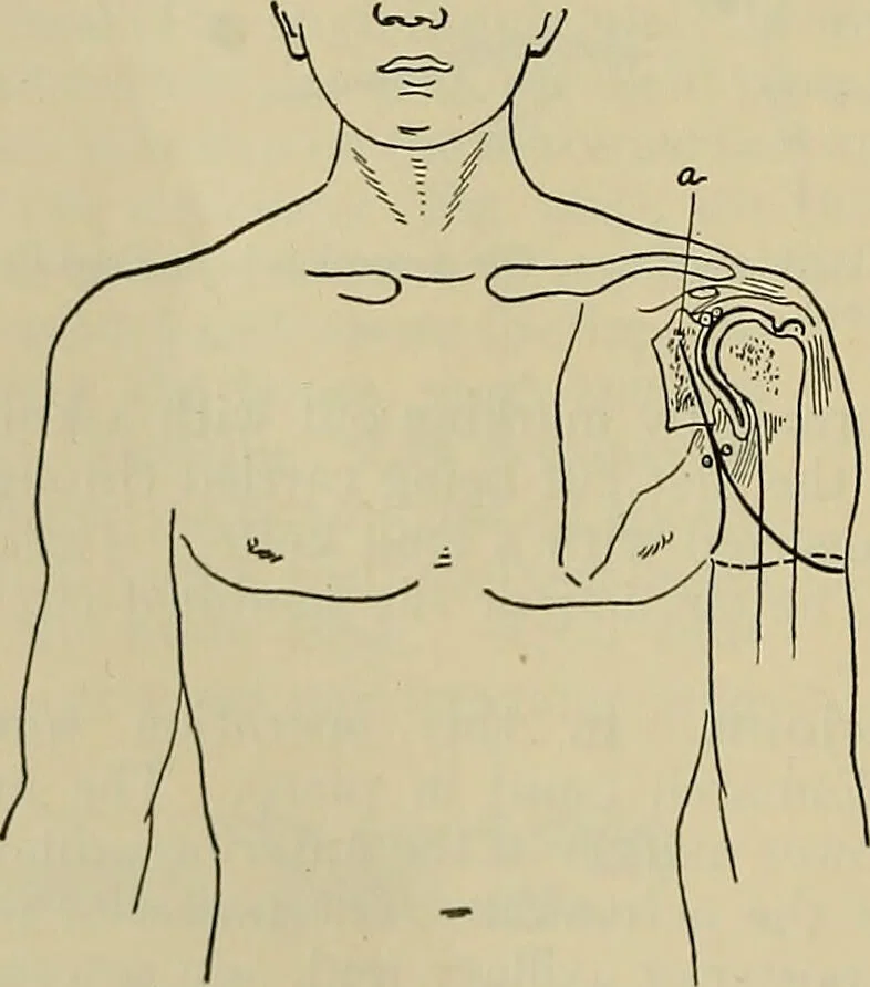 An illustration from Modern surgery, general and operative / by John Chalmers DaCosta., 1914, leaf 1456