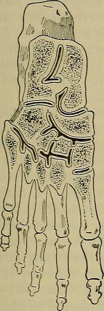 An illustration from Modern surgery, general and operative / by John Chalmers DaCosta., 1914, leaf 1459