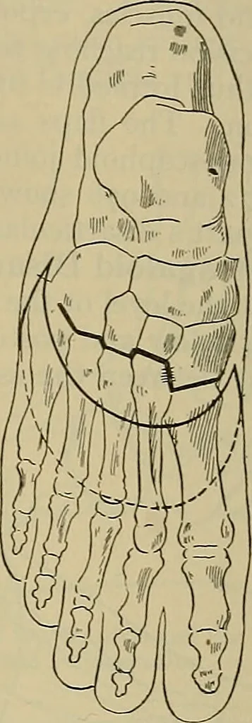 An illustration from Modern surgery, general and operative / by John Chalmers DaCosta., 1914, leaf 1459