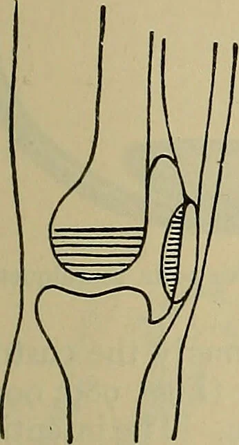 An illustration from Modern surgery, general and operative / by John Chalmers DaCosta., 1914, leaf 1463