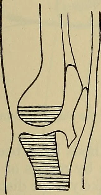 An illustration from Modern surgery, general and operative / by John Chalmers DaCosta., 1914, leaf 1463