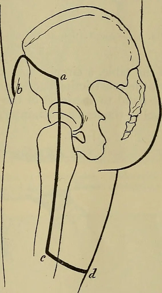 An illustration from Modern surgery, general and operative / by John Chalmers DaCosta., 1914, leaf 1465