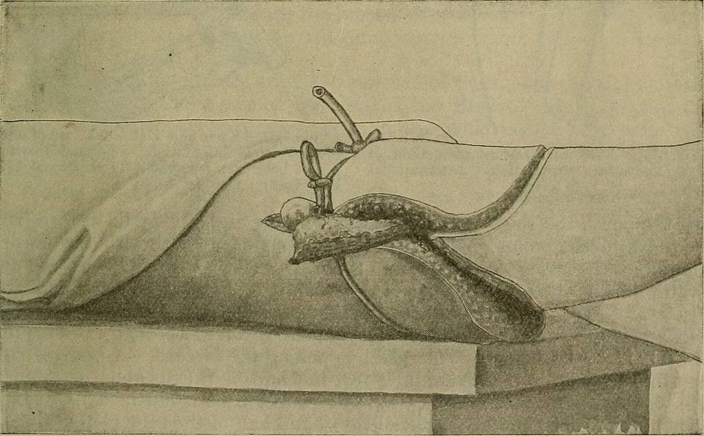 An illustration from Modern surgery, general and operative / by John Chalmers DaCosta., 1914, leaf 1467