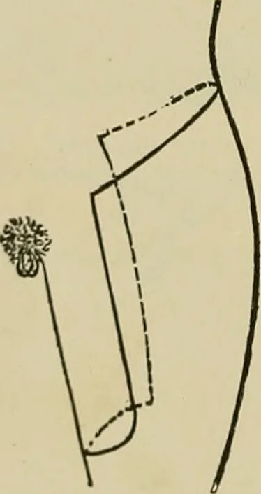 An illustration from Modern surgery, general and operative / by John Chalmers DaCosta., 1914, leaf 1468