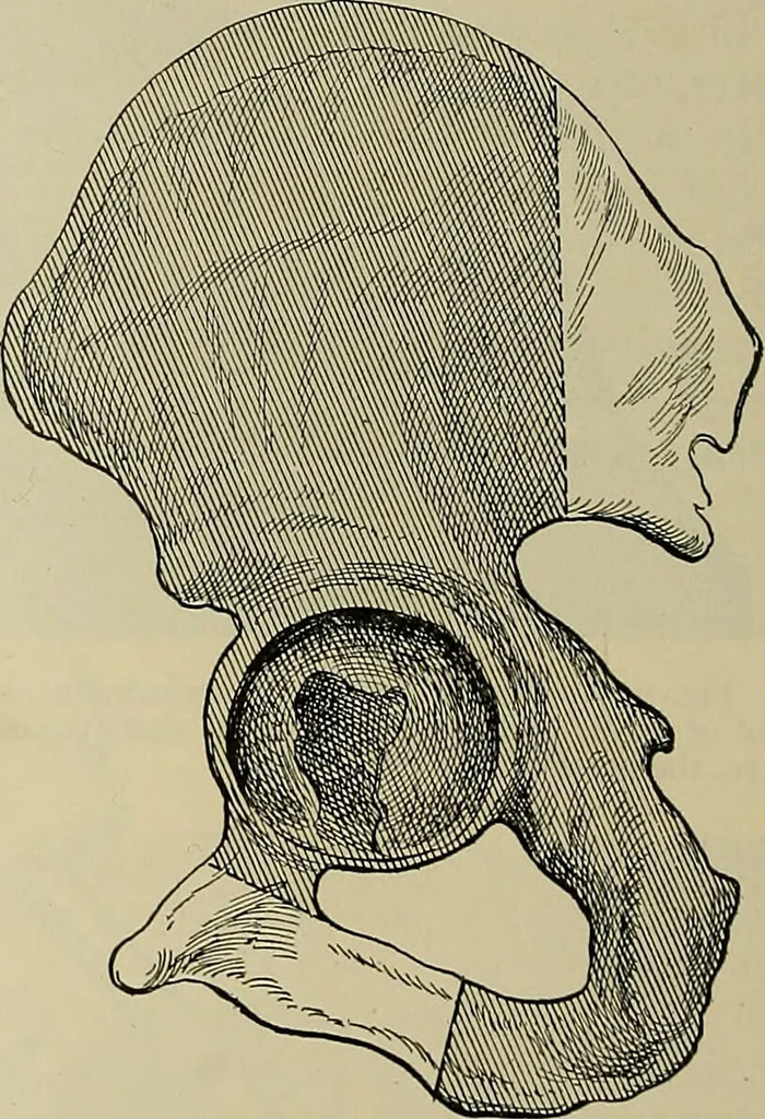 An illustration from Modern surgery, general and operative / by John Chalmers DaCosta., 1914, leaf 1468