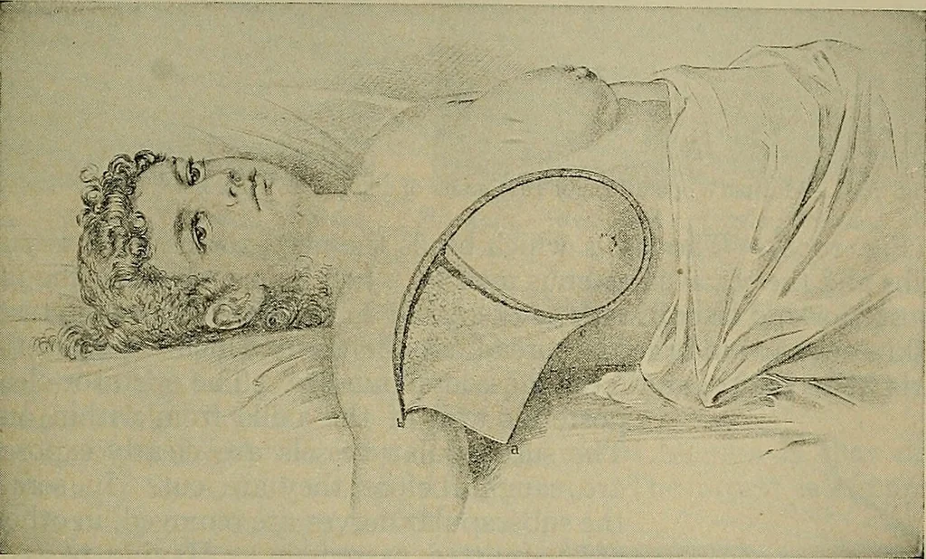An illustration from Modern surgery, general and operative / by John Chalmers DaCosta., 1914, leaf 1485