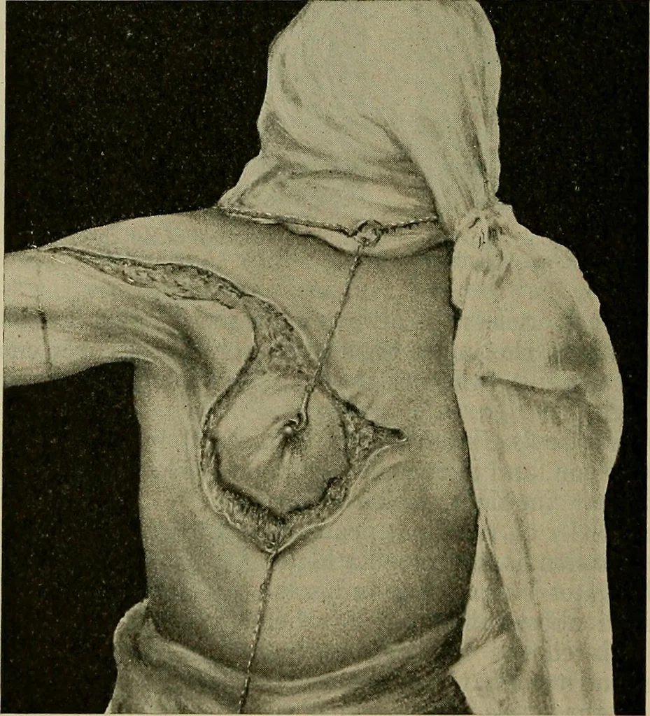 An illustration from Modern surgery, general and operative / by John Chalmers DaCosta., 1914, leaf 1488