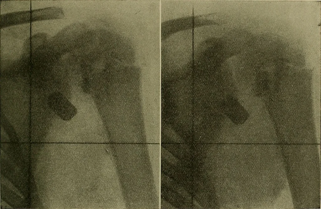 An illustration from Modern surgery, general and operative / by John Chalmers DaCosta., 1914, leaf 1507