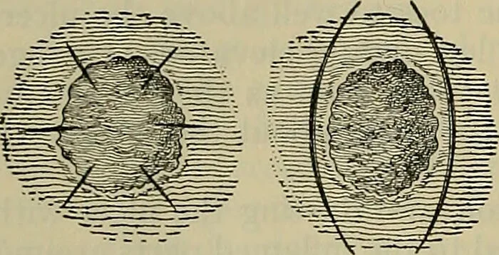 An illustration from Modern surgery, general and operative / by John Chalmers DaCosta., 1914, leaf 156