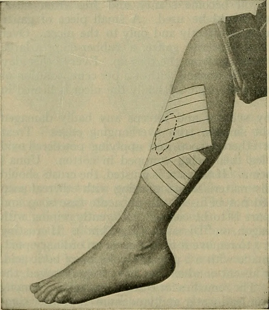 An illustration from Modern surgery, general and operative / by John Chalmers DaCosta., 1914, leaf 158