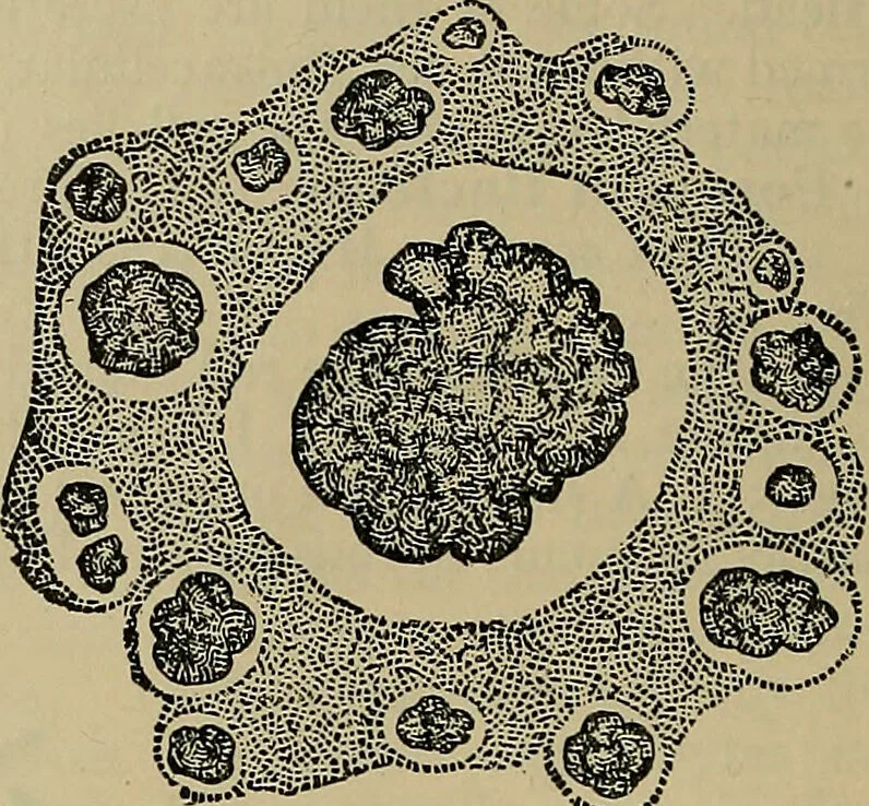 An illustration from Modern surgery, general and operative / by John Chalmers DaCosta., 1914, leaf 22
