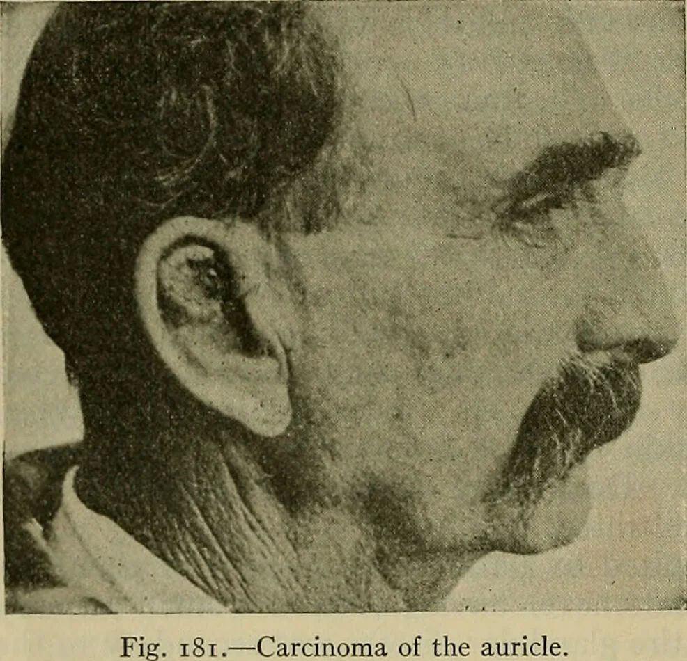 An illustration from Modern surgery, general and operative / by John Chalmers DaCosta., 1914, leaf 400