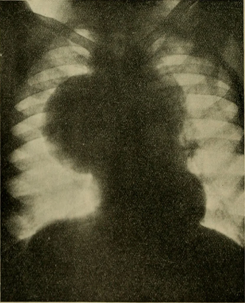 An illustration from Modern surgery, general and operative / by John Chalmers DaCosta., 1914, leaf 430