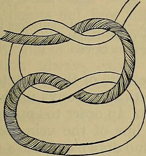 An illustration from Modern surgery, general and operative / by John Chalmers DaCosta., 1914, leaf 449