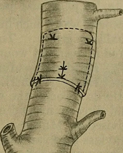 An illustration from Modern surgery, general and operative / by John Chalmers DaCosta., 1914, leaf 453