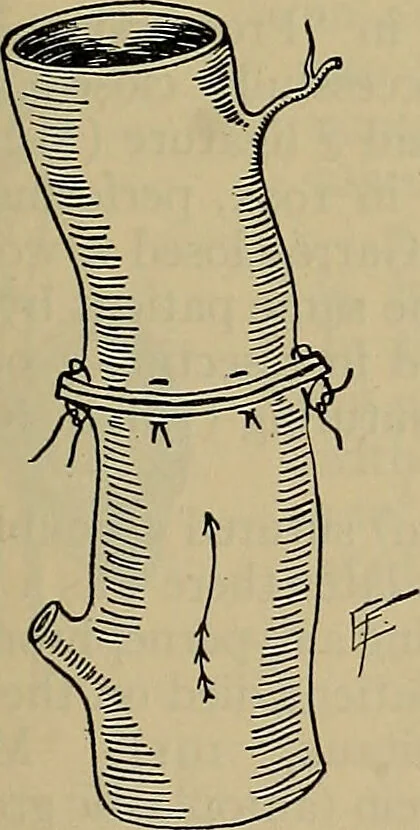 An illustration from Modern surgery, general and operative / by John Chalmers DaCosta., 1914, leaf 453