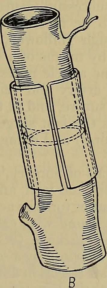 An illustration from Modern surgery, general and operative / by John Chalmers DaCosta., 1914, leaf 453