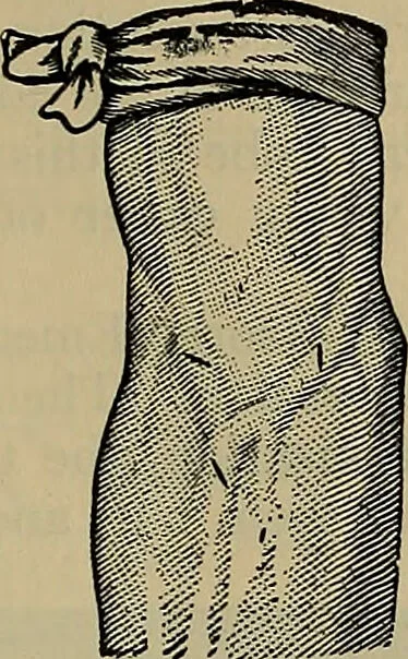 An illustration from Modern surgery, general and operative / by John Chalmers DaCosta., 1914, leaf 473