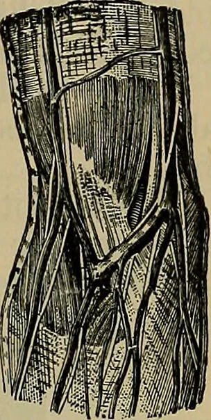 An illustration from Modern surgery, general and operative / by John Chalmers DaCosta., 1914, leaf 473