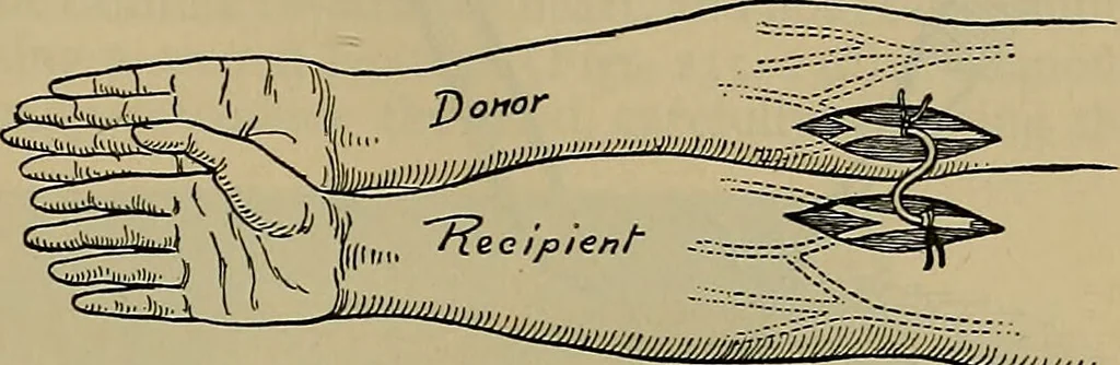 An illustration from Modern surgery, general and operative / by John Chalmers DaCosta., 1914, leaf 475