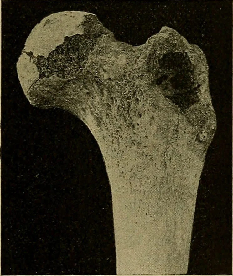 An illustration from Modern surgery, general and operative / by John Chalmers DaCosta., 1914, leaf 515