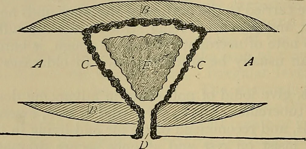 An illustration from Modern surgery, general and operative / by John Chalmers DaCosta., 1914, leaf 518