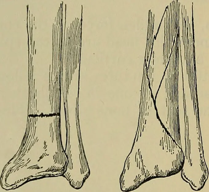 An illustration from Modern surgery, general and operative / by John Chalmers DaCosta., 1914, leaf 532