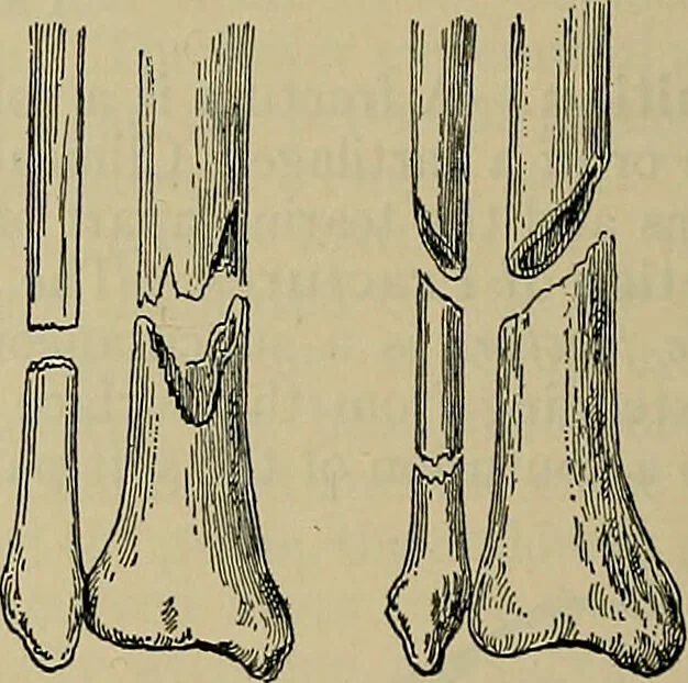 An illustration from Modern surgery, general and operative / by John Chalmers DaCosta., 1914, leaf 532