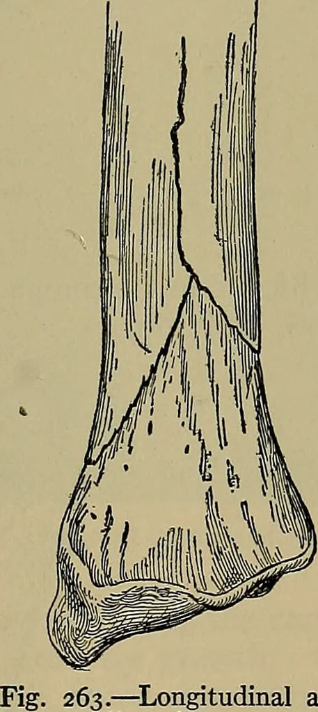 An illustration from Modern surgery, general and operative / by John Chalmers DaCosta., 1914, leaf 533