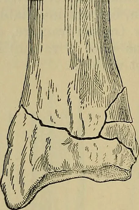 An illustration from Modern surgery, general and operative / by John Chalmers DaCosta., 1914, leaf 534