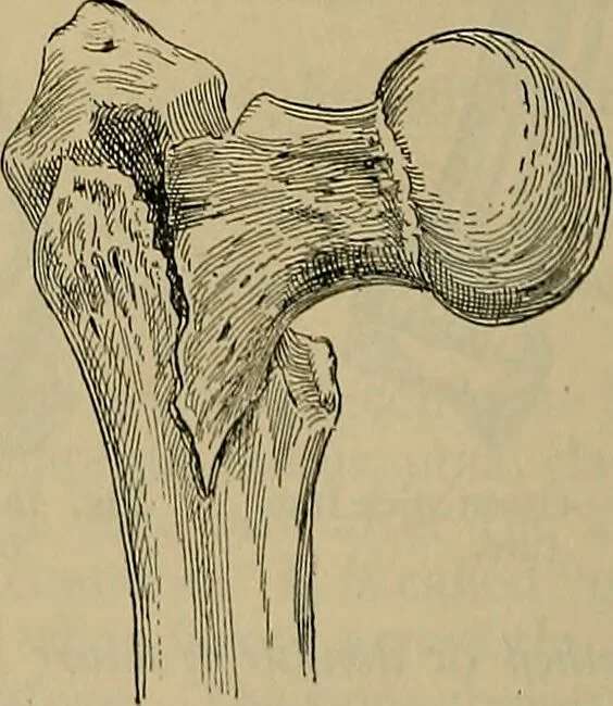 An illustration from Modern surgery, general and operative / by John Chalmers DaCosta., 1914, leaf 534