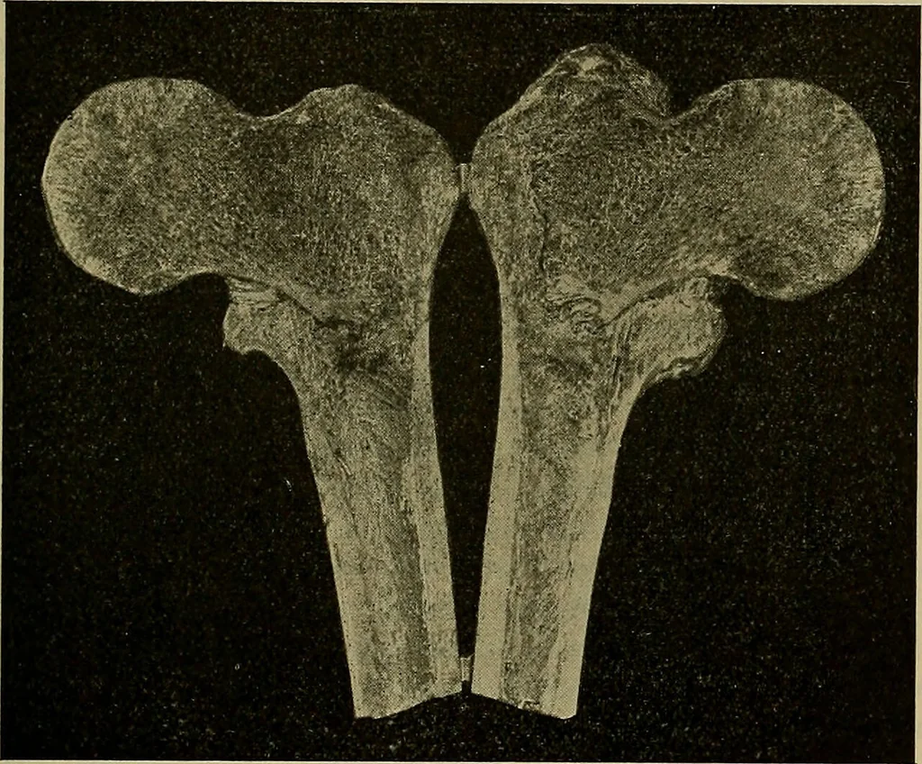 An illustration from Modern surgery, general and operative / by John Chalmers DaCosta., 1914, leaf 535