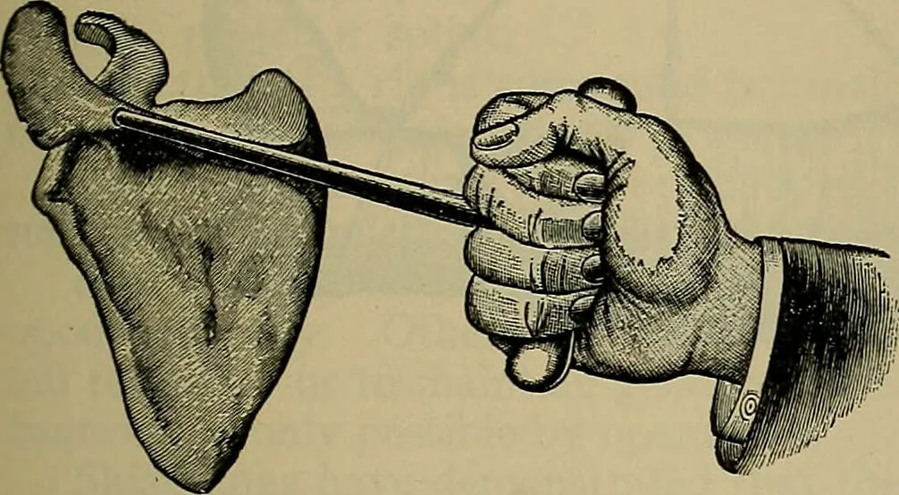 An illustration from Modern surgery, general and operative / by John Chalmers DaCosta., 1914, leaf 549