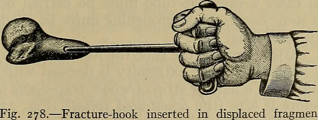 An illustration from Modern surgery, general and operative / by John Chalmers DaCosta., 1914, leaf 549