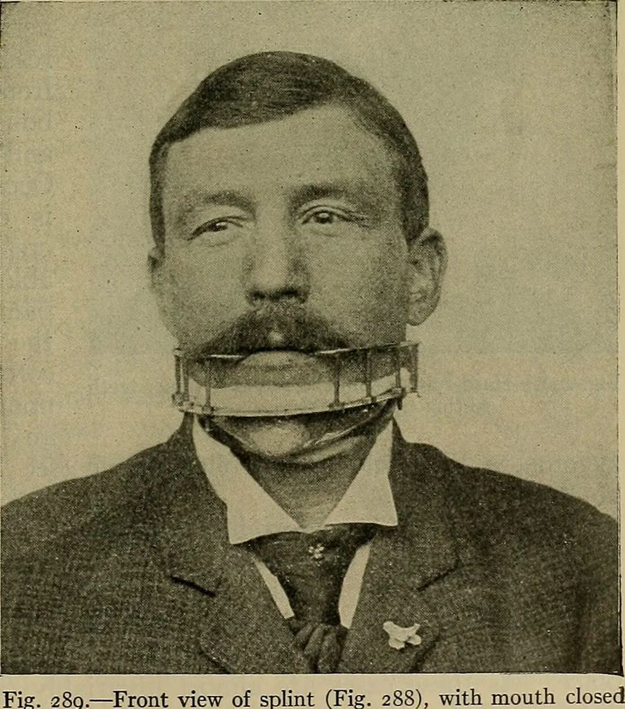 An illustration from Modern surgery, general and operative / by John Chalmers DaCosta., 1914, leaf 557