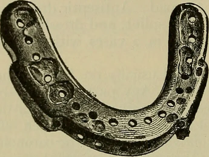 An illustration from Modern surgery, general and operative / by John Chalmers DaCosta., 1914, leaf 560