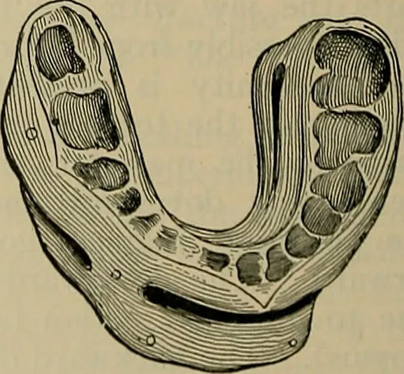 An illustration from Modern surgery, general and operative / by John Chalmers DaCosta., 1914, leaf 560