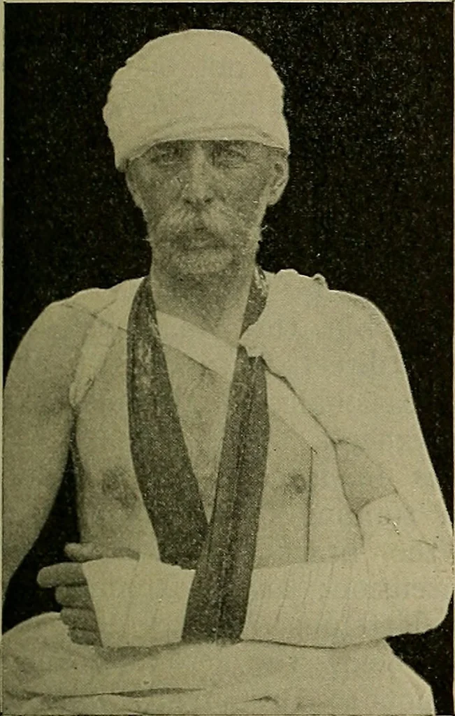 An illustration from Modern surgery, general and operative / by John Chalmers DaCosta., 1914, leaf 575