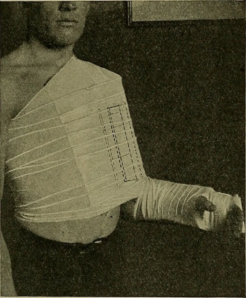 An illustration from Modern surgery, general and operative / by John Chalmers DaCosta., 1914, leaf 579