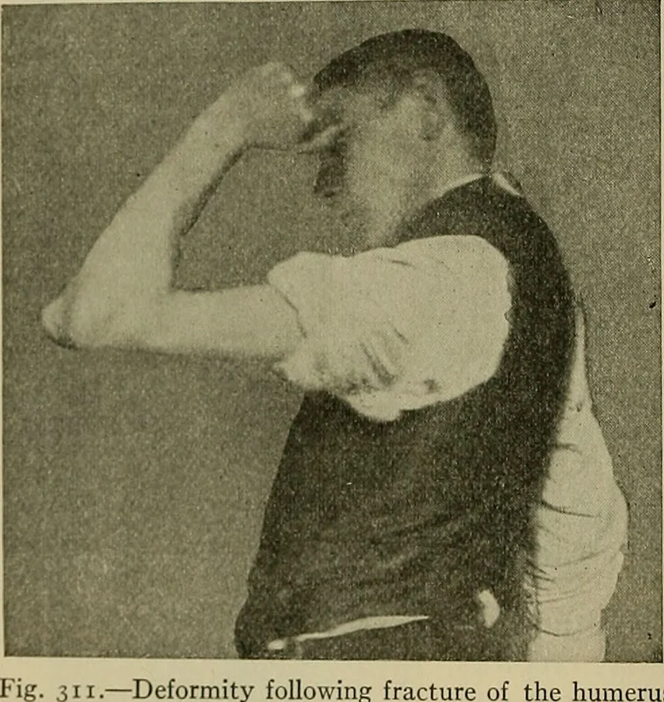 An illustration from Modern surgery, general and operative / by John Chalmers DaCosta., 1914, leaf 584