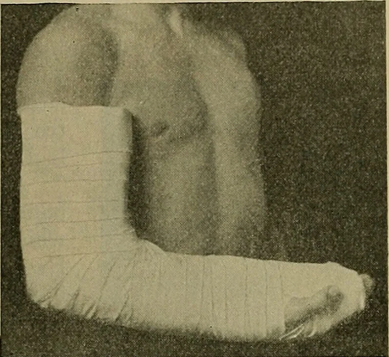 An illustration from Modern surgery, general and operative / by John Chalmers DaCosta., 1914, leaf 585