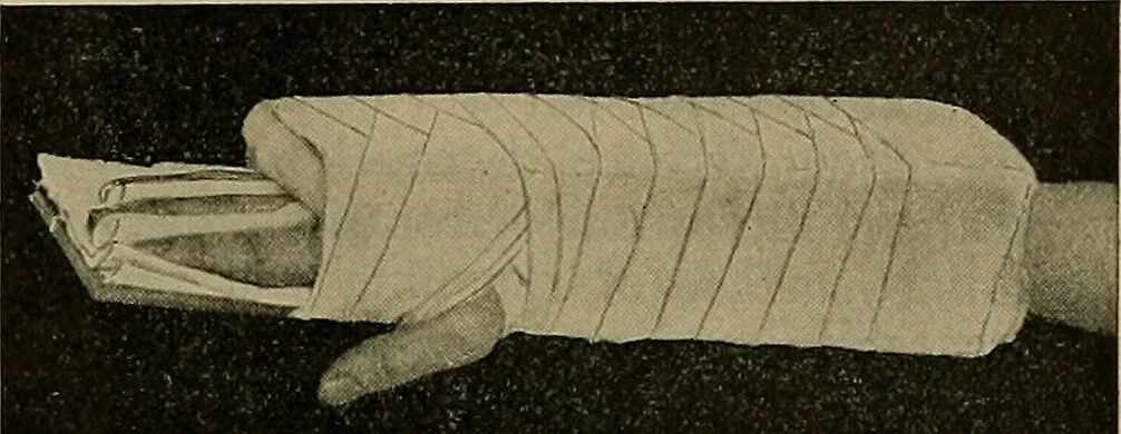An illustration from Modern surgery, general and operative / by John Chalmers DaCosta., 1914, leaf 591