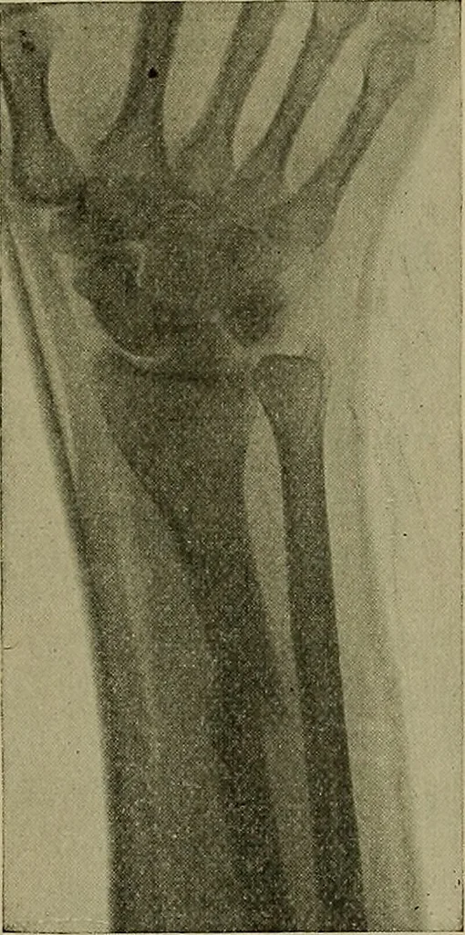 An illustration from Modern surgery, general and operative / by John Chalmers DaCosta., 1914, leaf 593