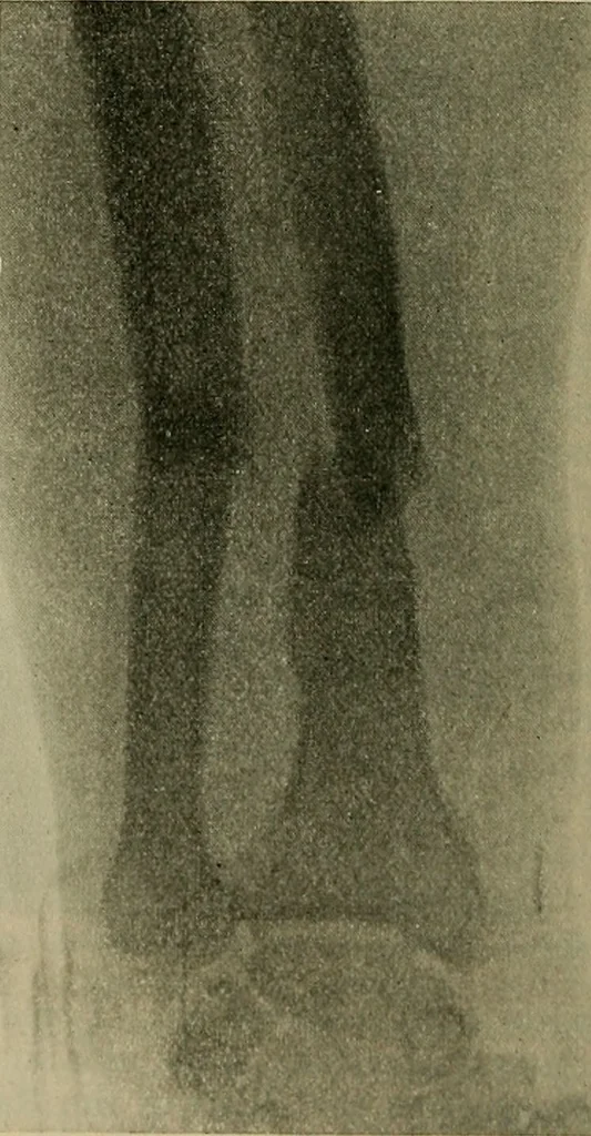An illustration from Modern surgery, general and operative / by John Chalmers DaCosta., 1914, leaf 594