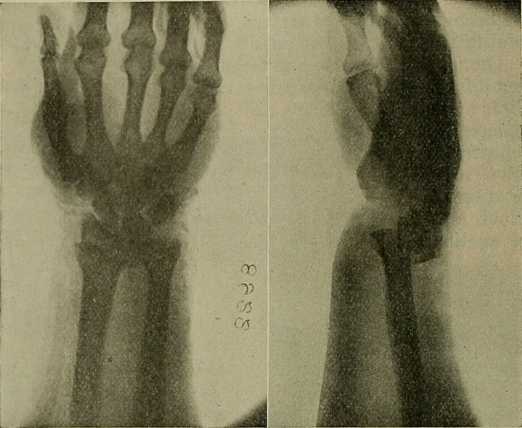 An illustration from Modern surgery, general and operative / by John Chalmers DaCosta., 1914, leaf 596