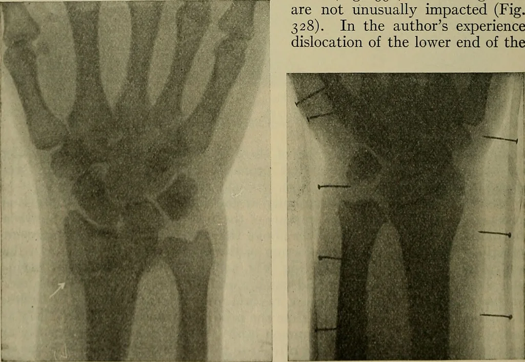 An illustration from Modern surgery, general and operative / by John Chalmers DaCosta., 1914, leaf 596