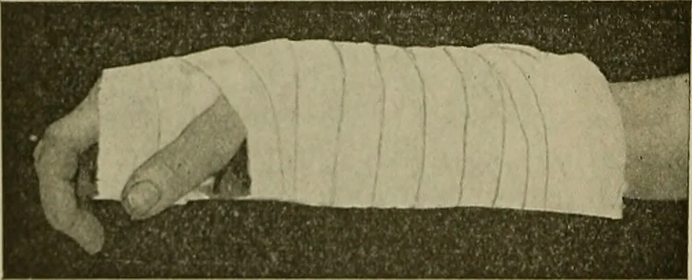 An illustration from Modern surgery, general and operative / by John Chalmers DaCosta., 1914, leaf 598