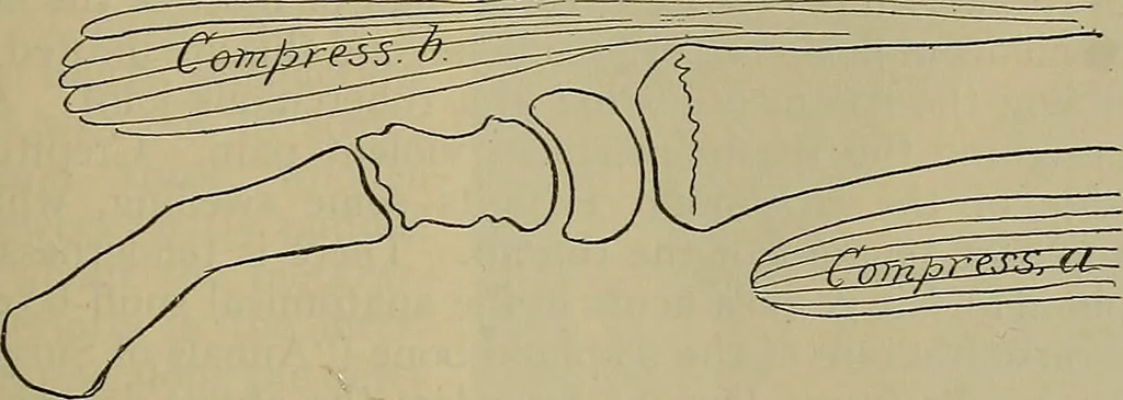 An illustration from Modern surgery, general and operative / by John Chalmers DaCosta., 1914, leaf 599